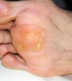 Callous on foot